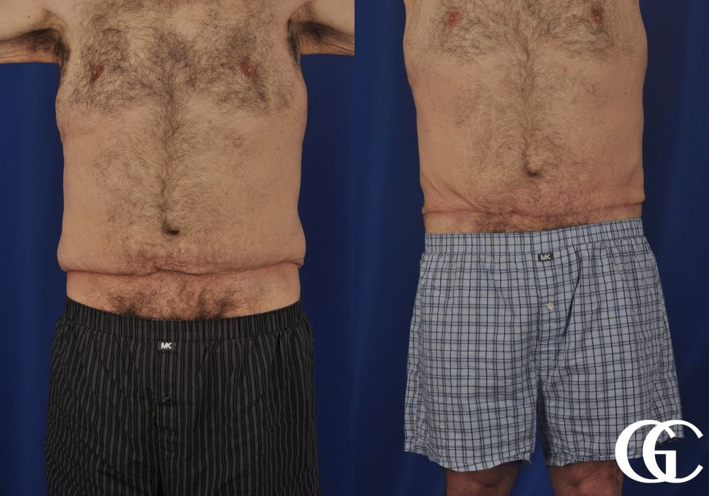 Liposuction - Thumbnail 2