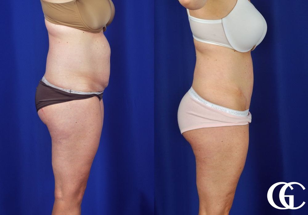 Liposuction - Thumbnail 4