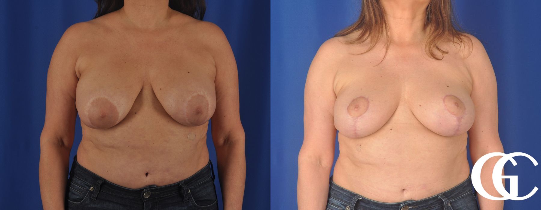 Liposuction - Thumbnail 2