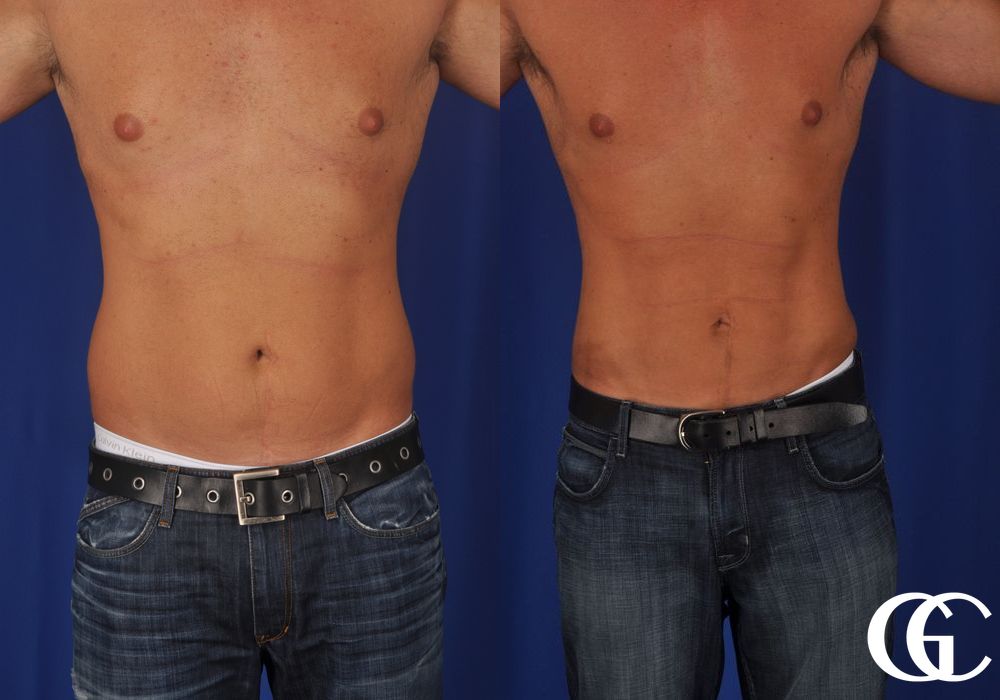 Liposuction - Thumbnail 2