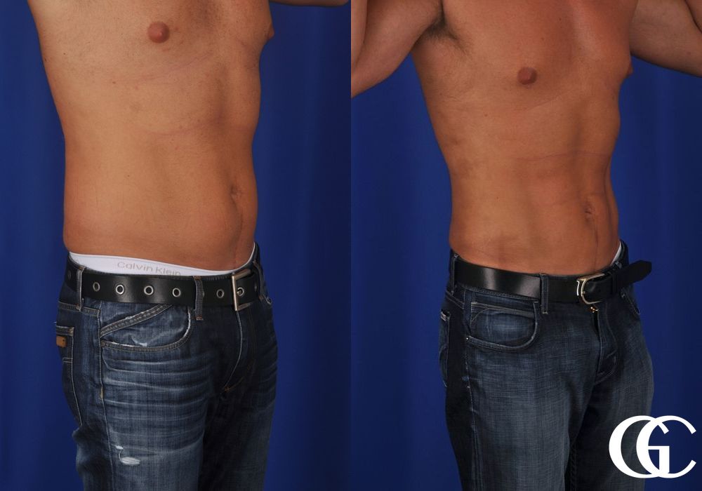 Liposuction - Thumbnail 3