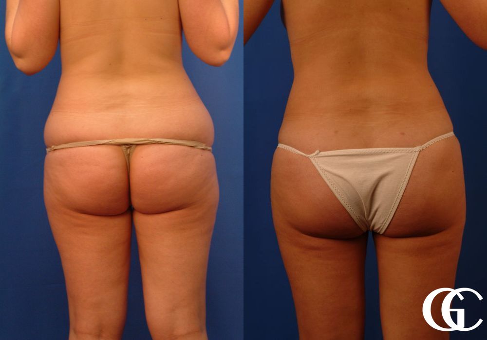 Liposuction - Thumbnail 5