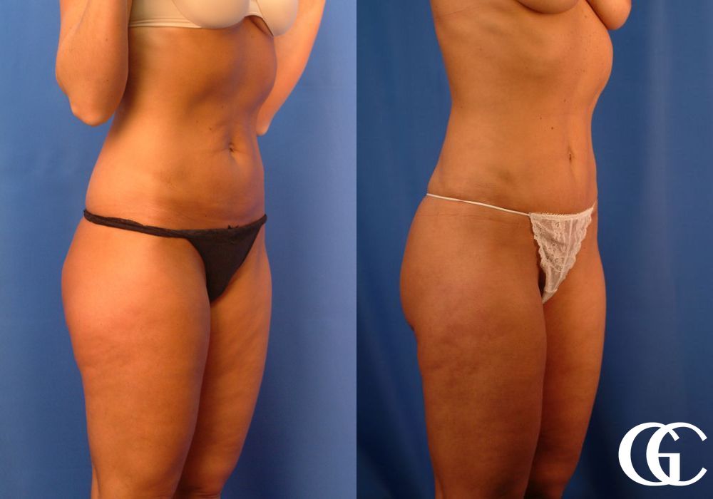 Liposuction - Thumbnail 3