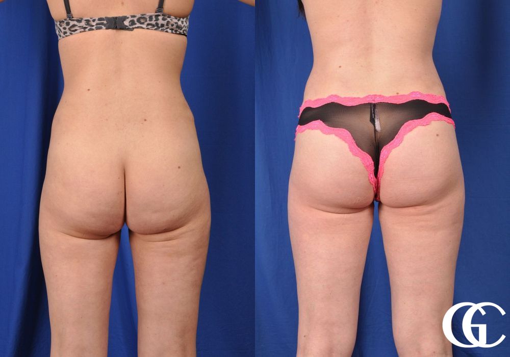 Liposuction - Thumbnail 4