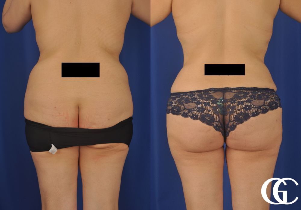 Tummy Tuck - Thumbnail 2