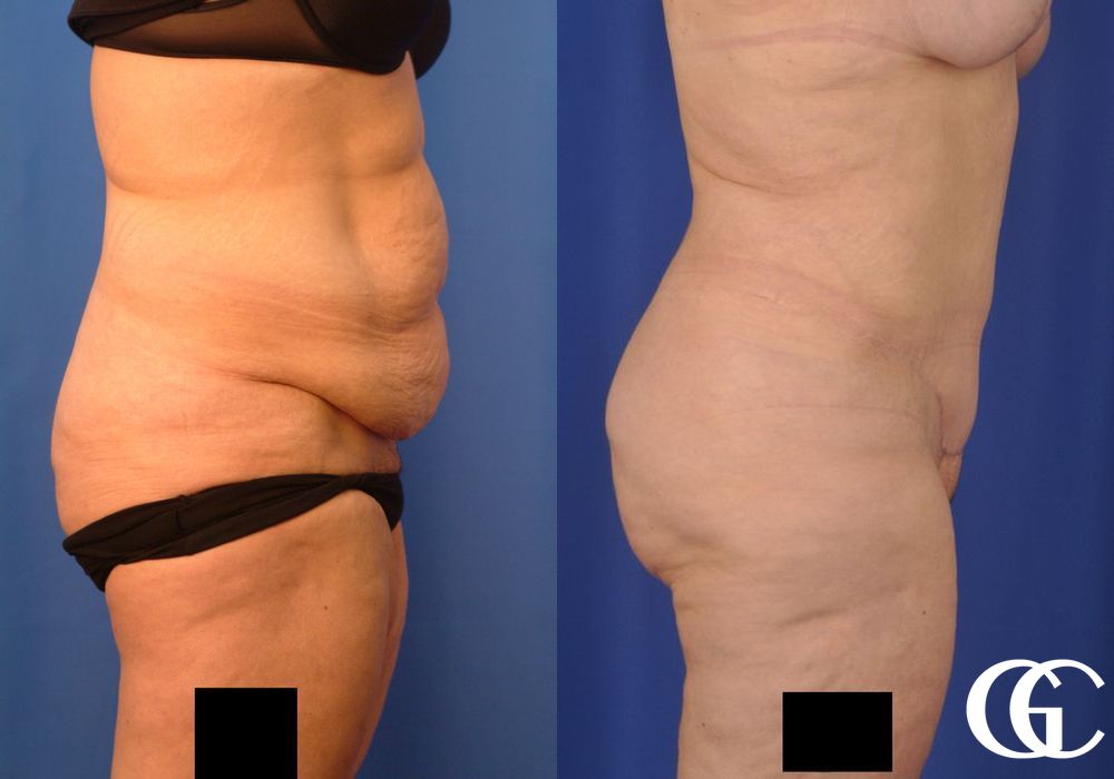 Tummy Tuck - Thumbnail 3