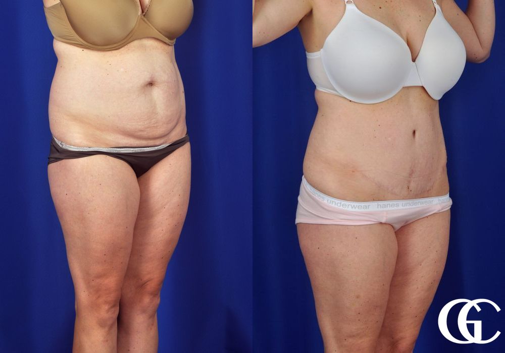 Liposuction - Thumbnail 3