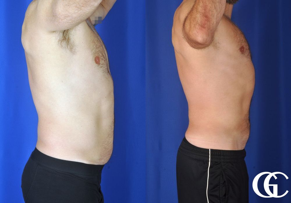 Liposuction - Thumbnail 4