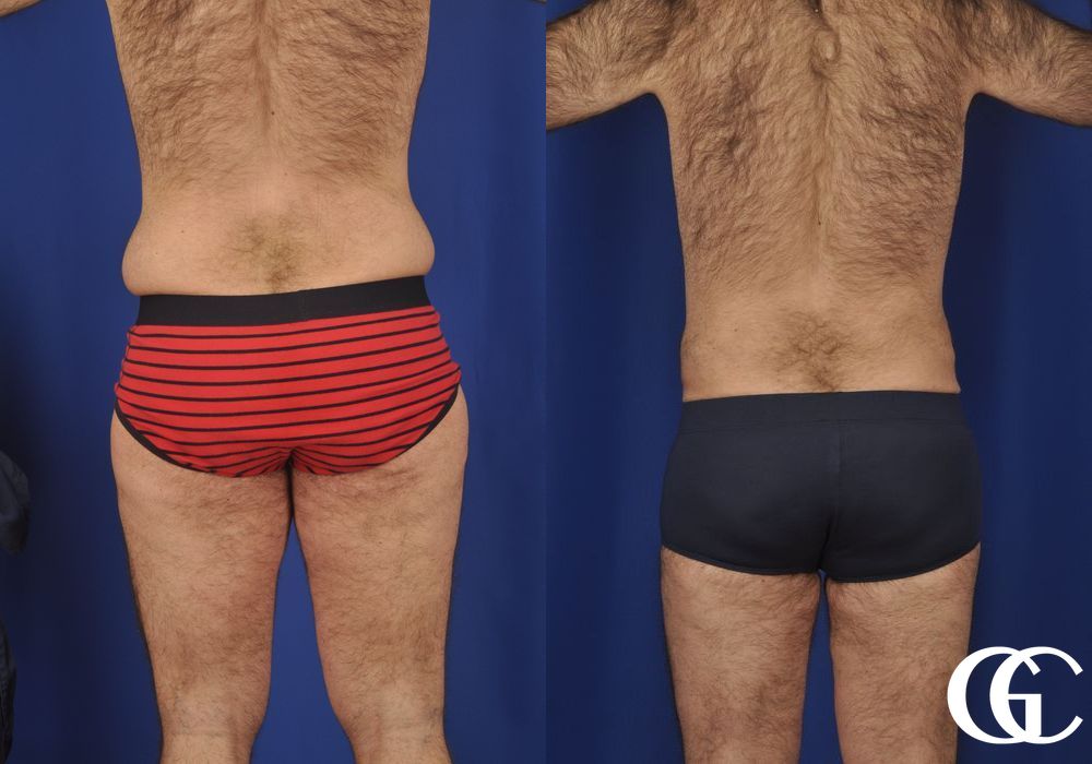 Liposuction - Case 6968