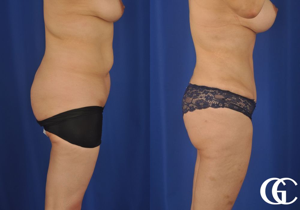 Tummy Tuck - Thumbnail 5