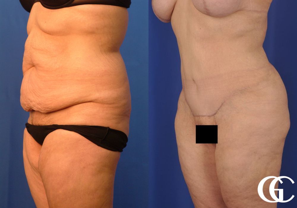 Tummy Tuck - Thumbnail 4