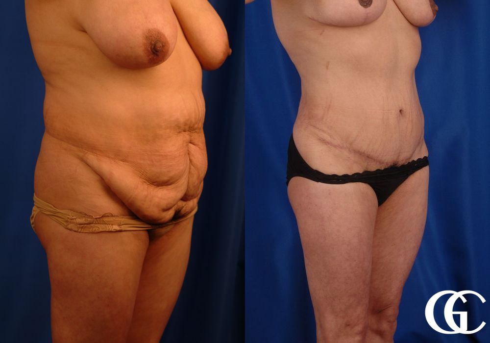 VASER® Lipo - Thumbnail 3