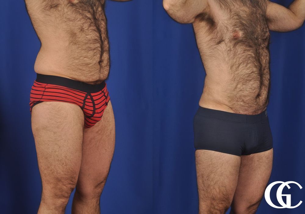 Liposuction - Thumbnail 4