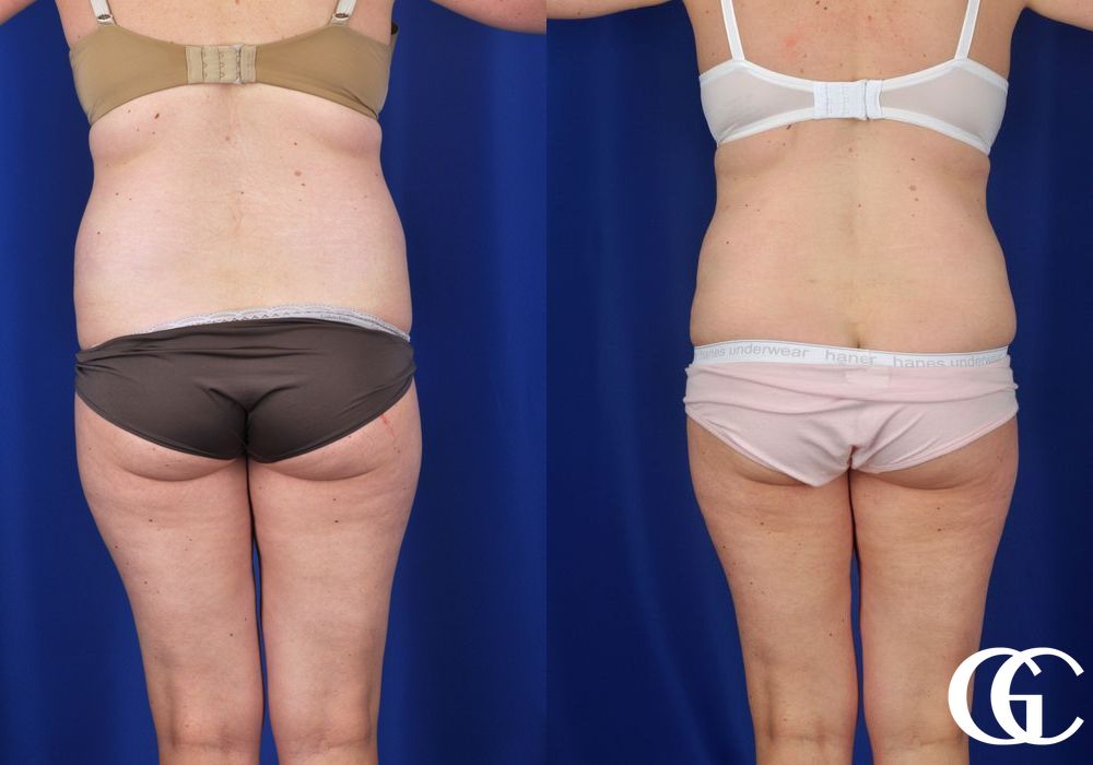 Liposuction - Thumbnail 5