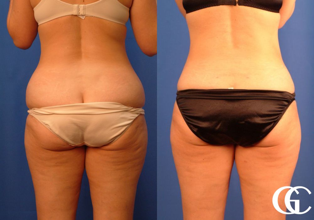 VASER® Lipo - Thumbnail 4