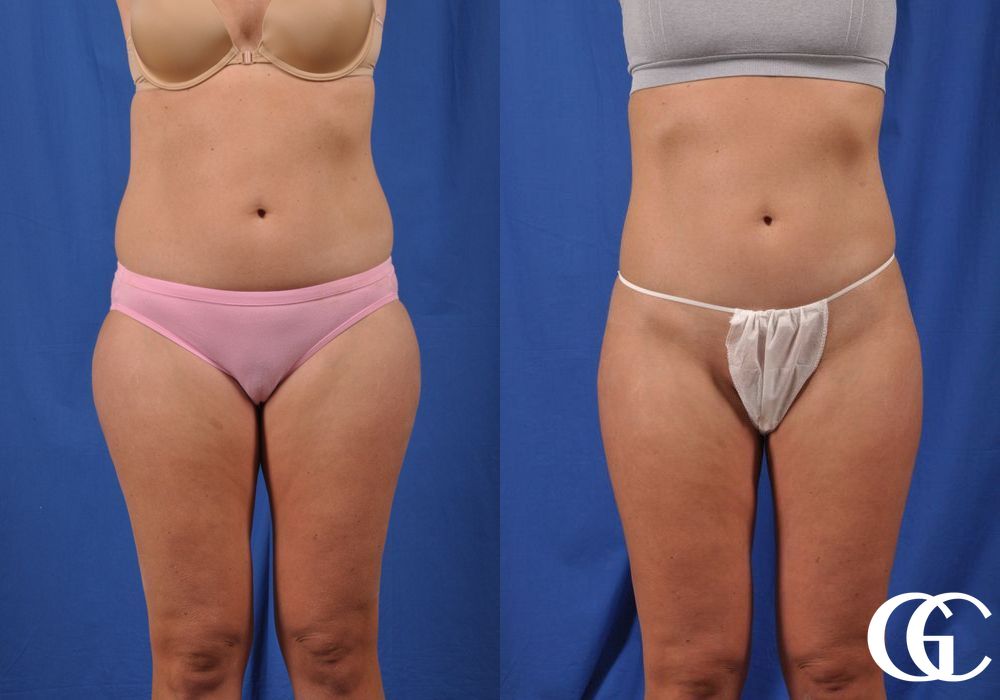 Liposuction - Thumbnail 2