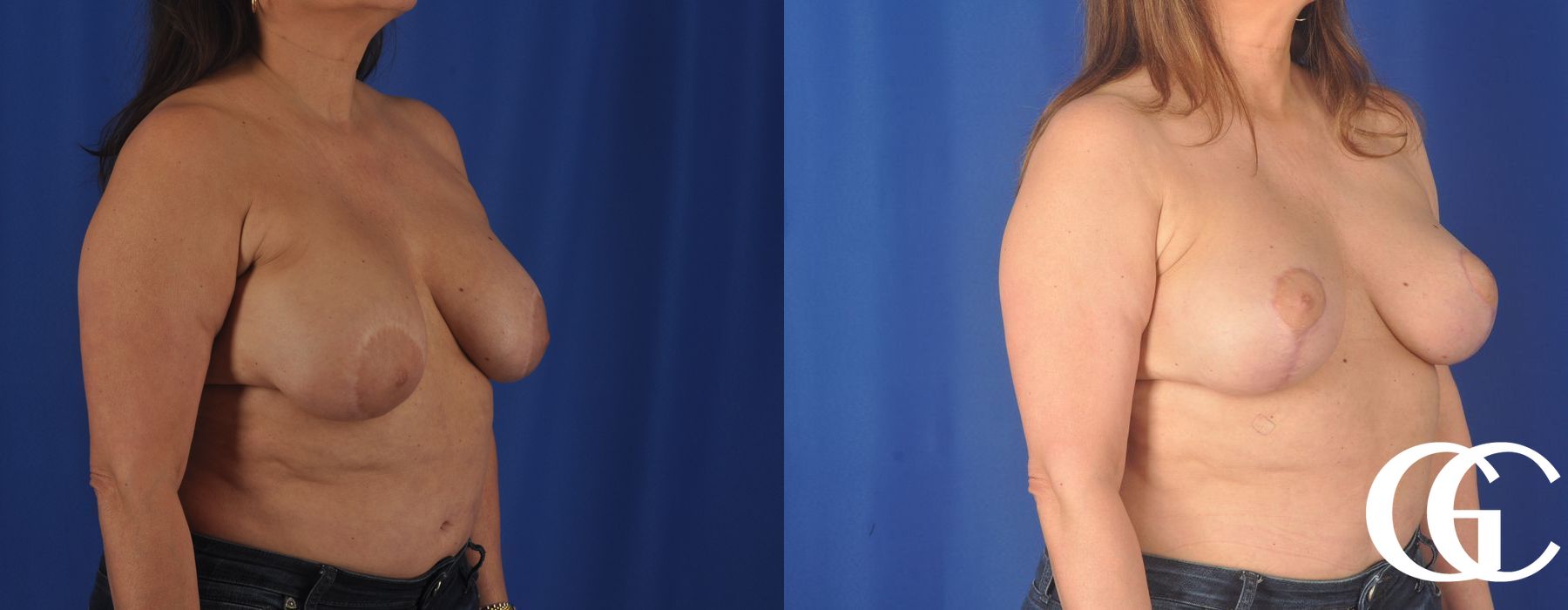 Liposuction - Thumbnail 3