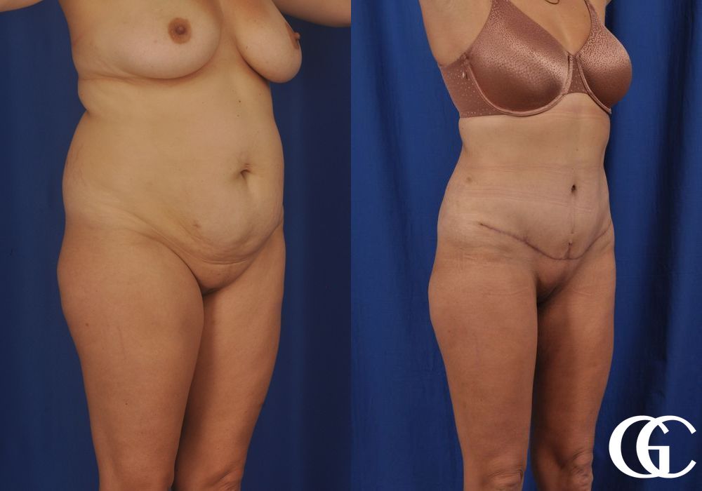 Liposuction - Case 6980