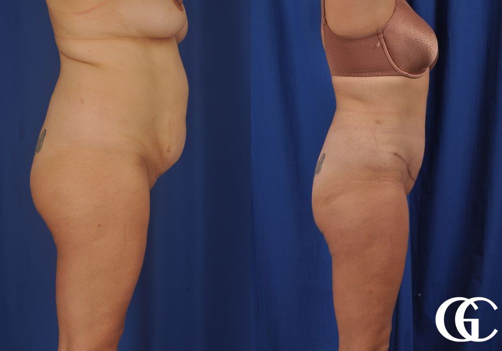 Liposuction - Thumbnail 3