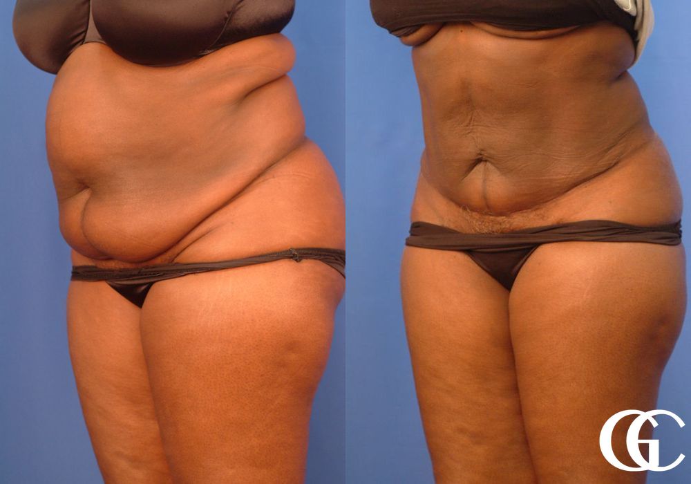 VASER® Lipo - Thumbnail 5