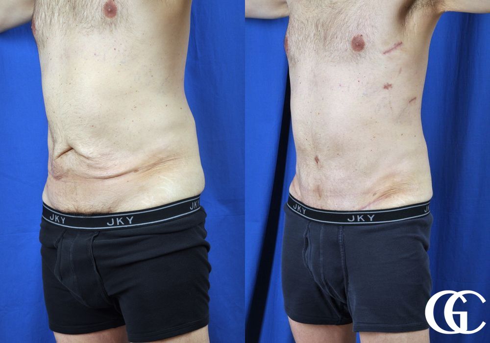 Liposuction - Thumbnail 4