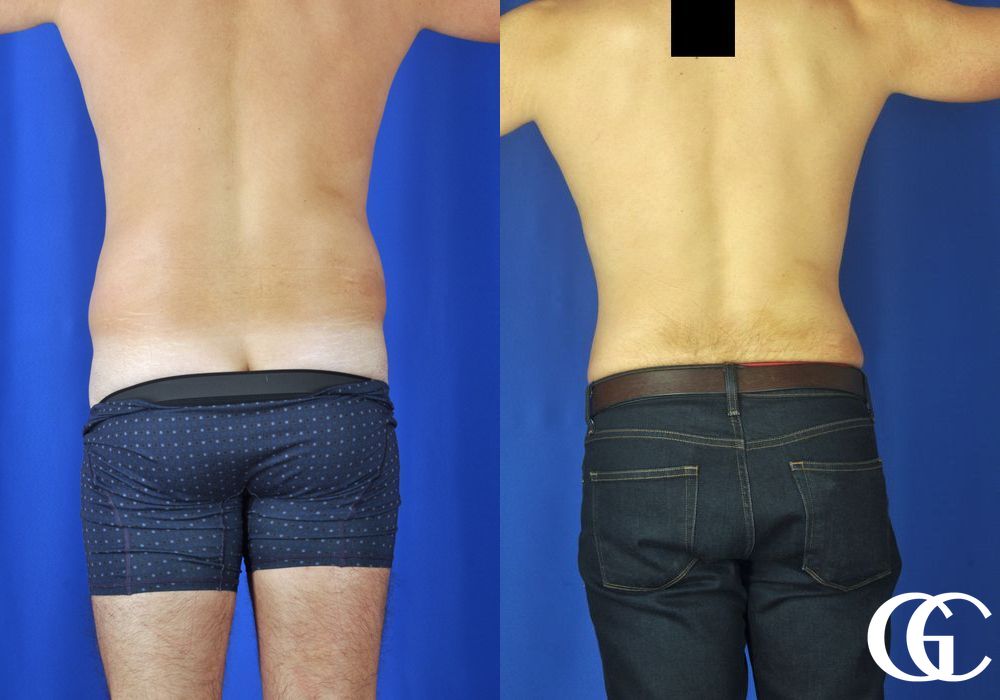 Liposuction - Thumbnail 4