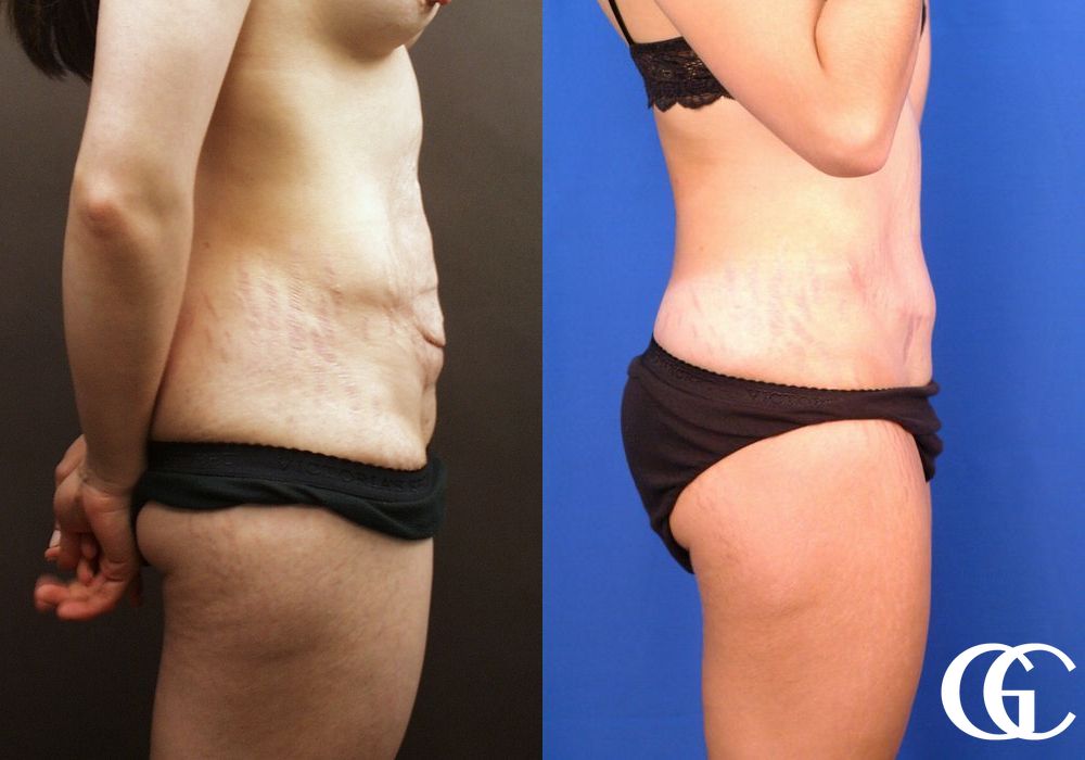 Tummy Tuck - Case 6997