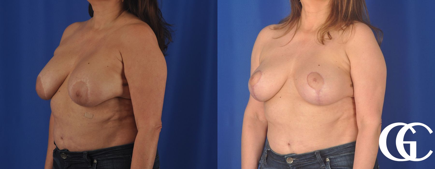 Liposuction - Thumbnail 4