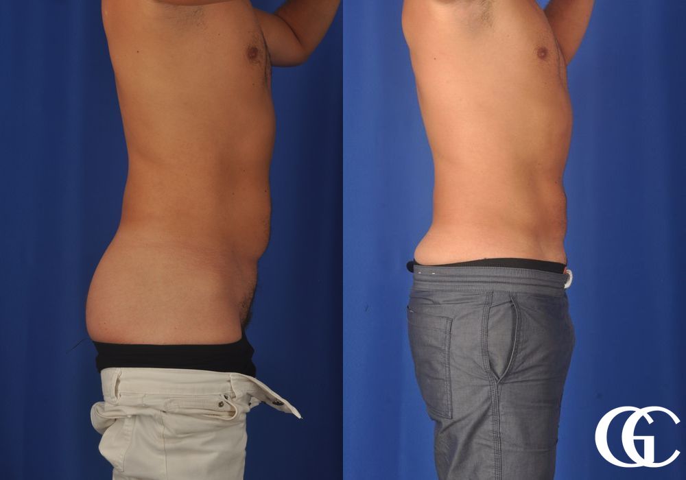 Liposuction - Thumbnail 4