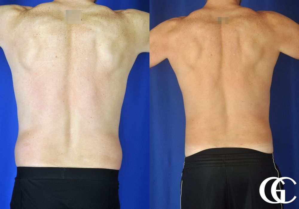 Liposuction - Thumbnail 5