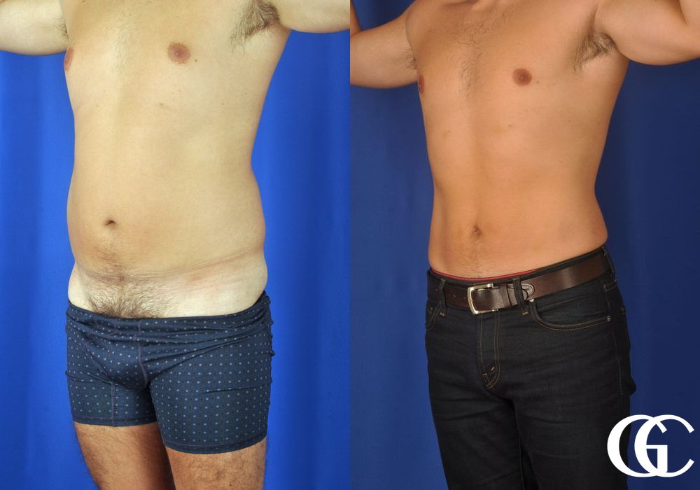 Liposuction - Thumbnail 5