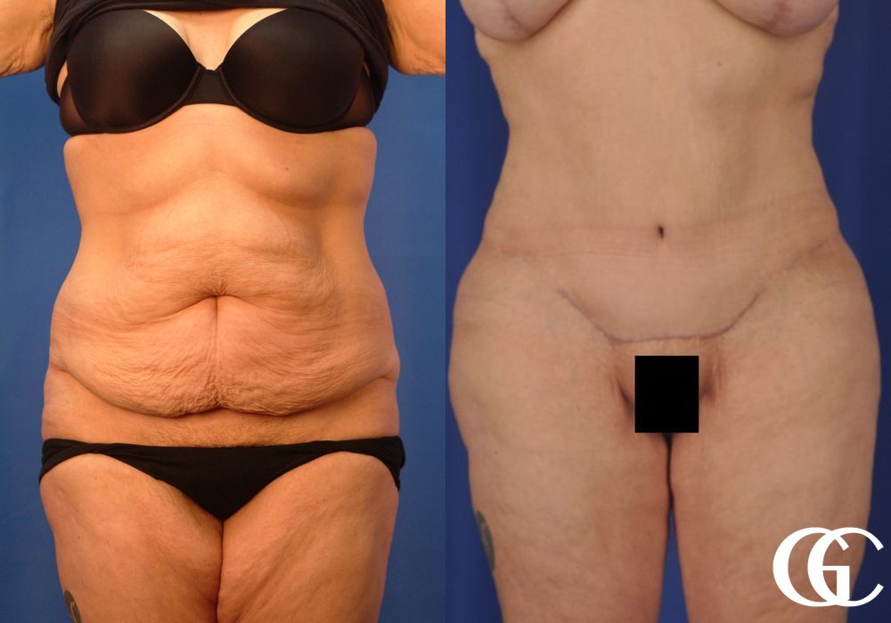 Tummy Tuck - Thumbnail 2