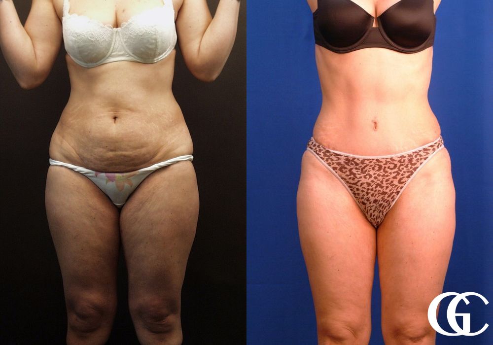 Liposuction - Case 6929