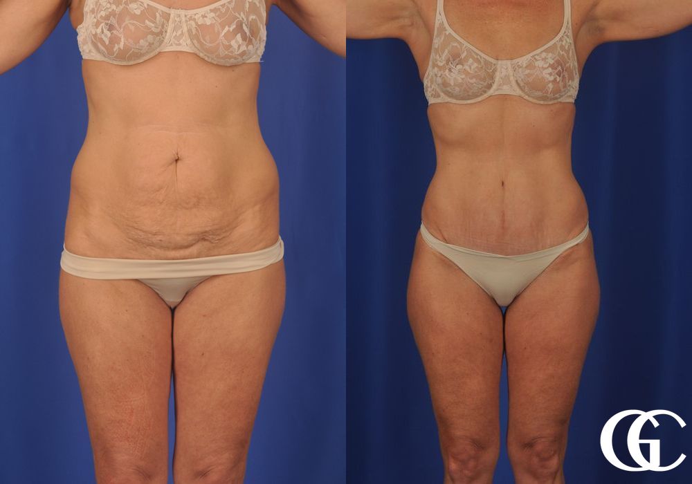 Lipoabdominoplasty - Thumbnail 2