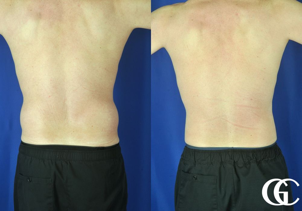 Liposuction - Thumbnail 5