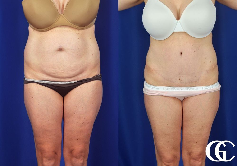 Liposuction - Thumbnail 2