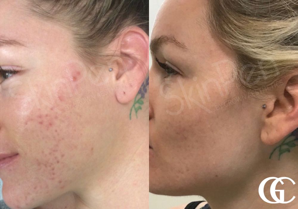 SkinPen® - Case 7461