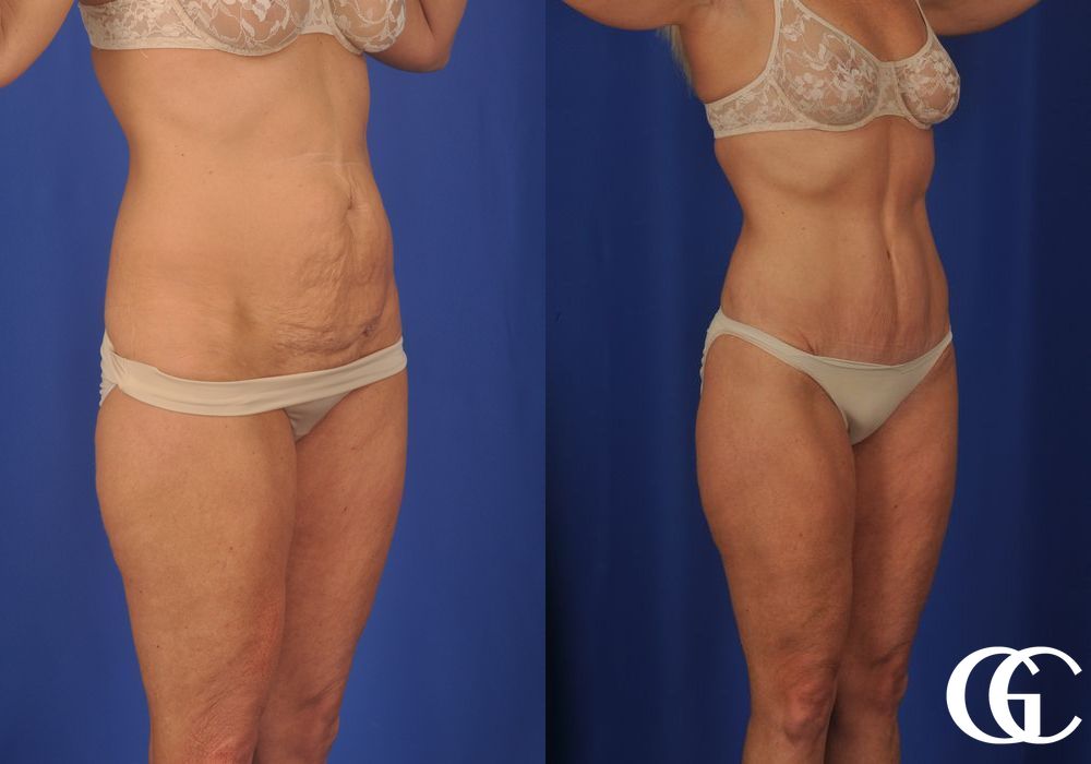 Lipoabdominoplasty - Thumbnail 3