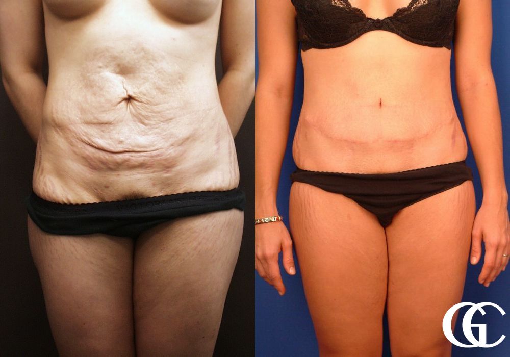 Tummy Tuck - Thumbnail 2