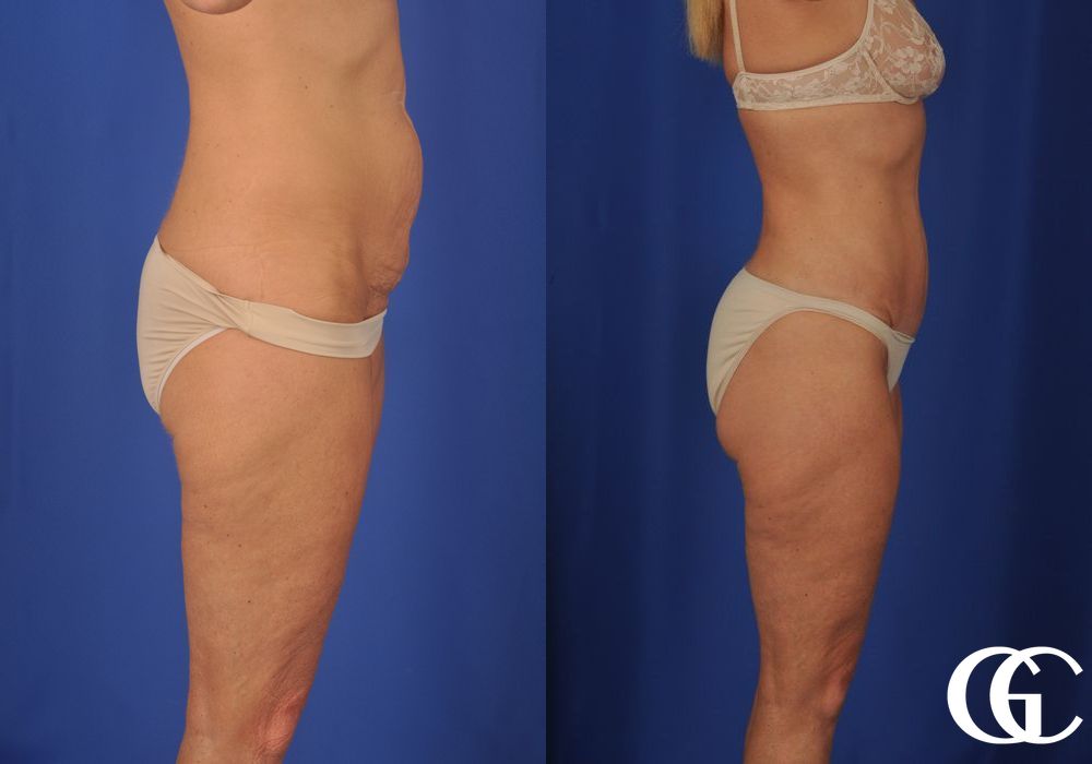 Lipoabdominoplasty - Case 6914