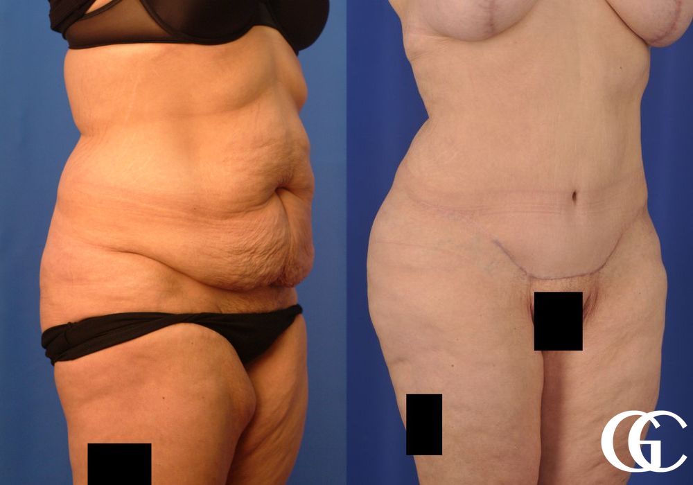 Tummy Tuck - Case 7005