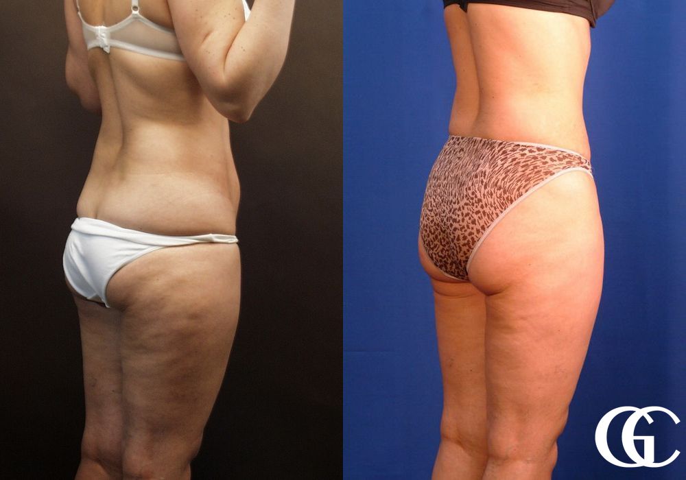 Liposuction - Thumbnail 4