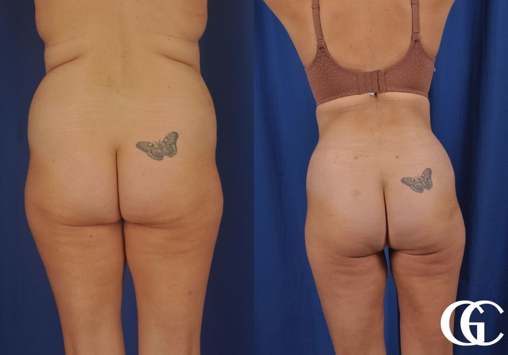 Liposuction - Thumbnail 4