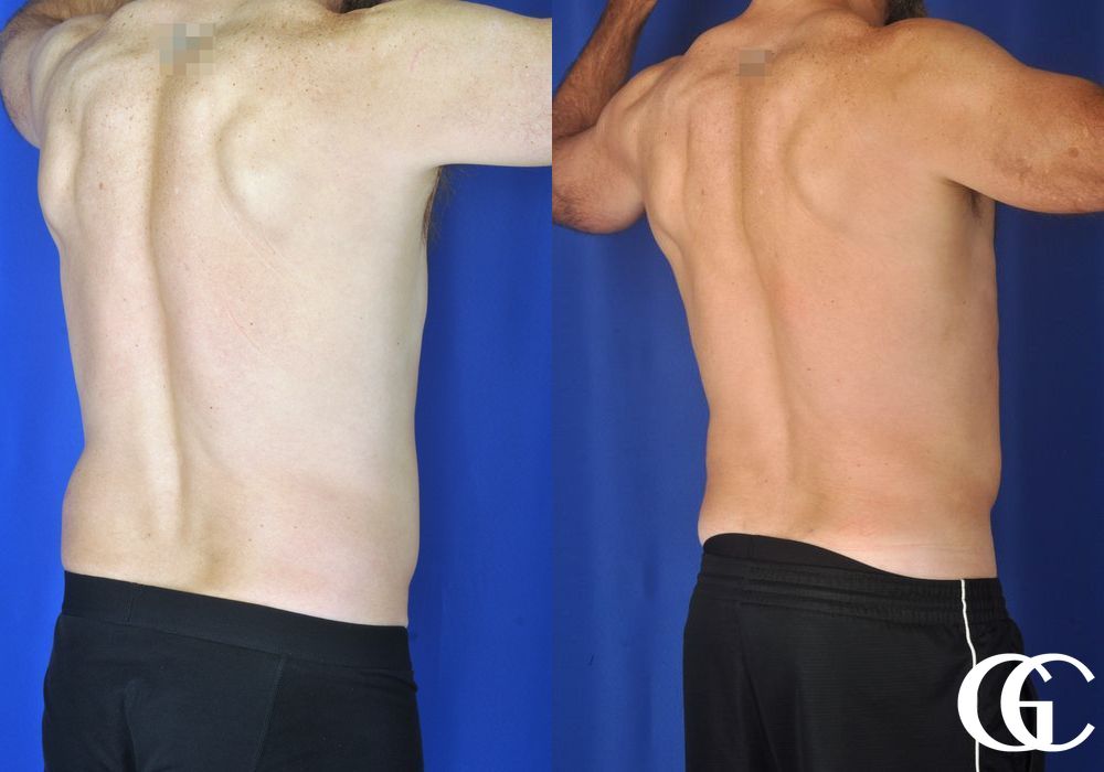 Liposuction - Case 6963