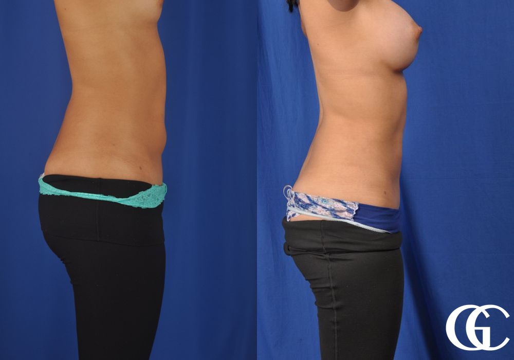 Liposuction - Thumbnail 3