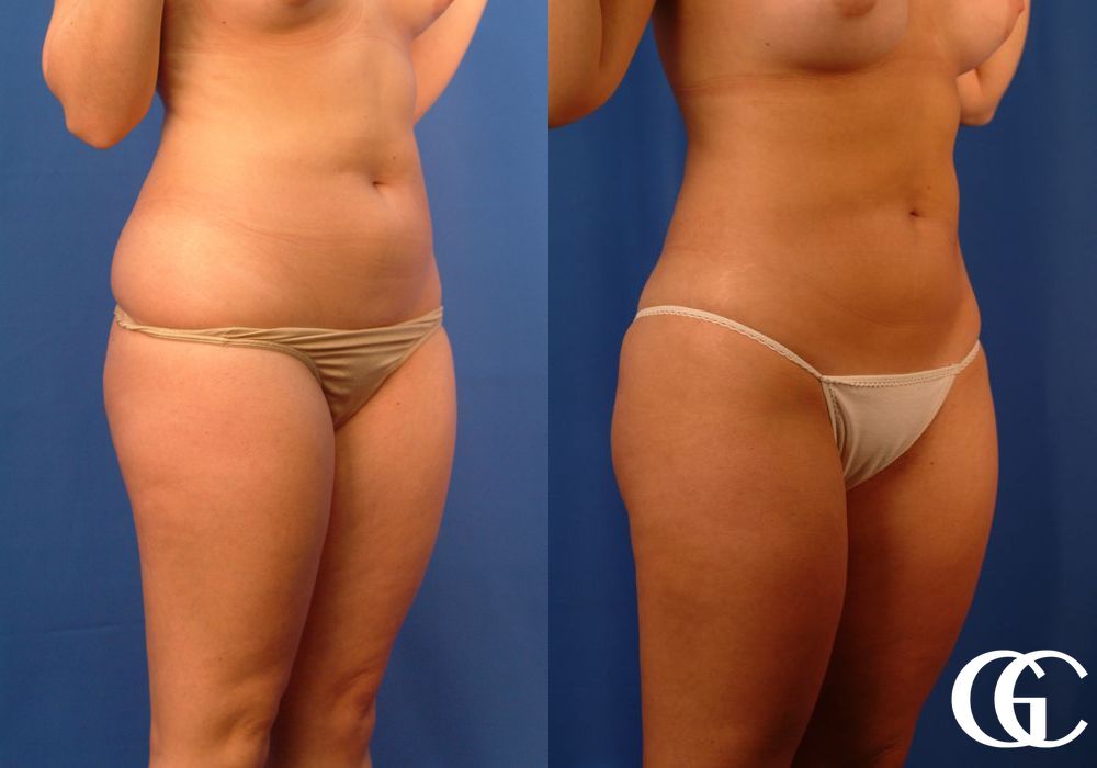 Liposuction - Thumbnail 4