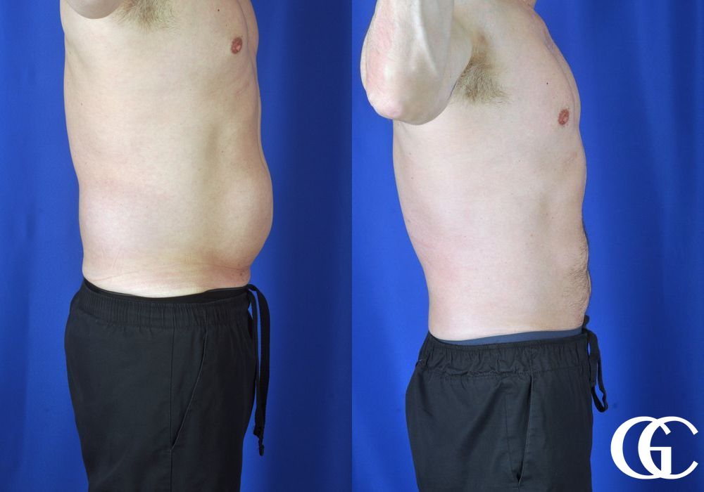 Liposuction - Thumbnail 4