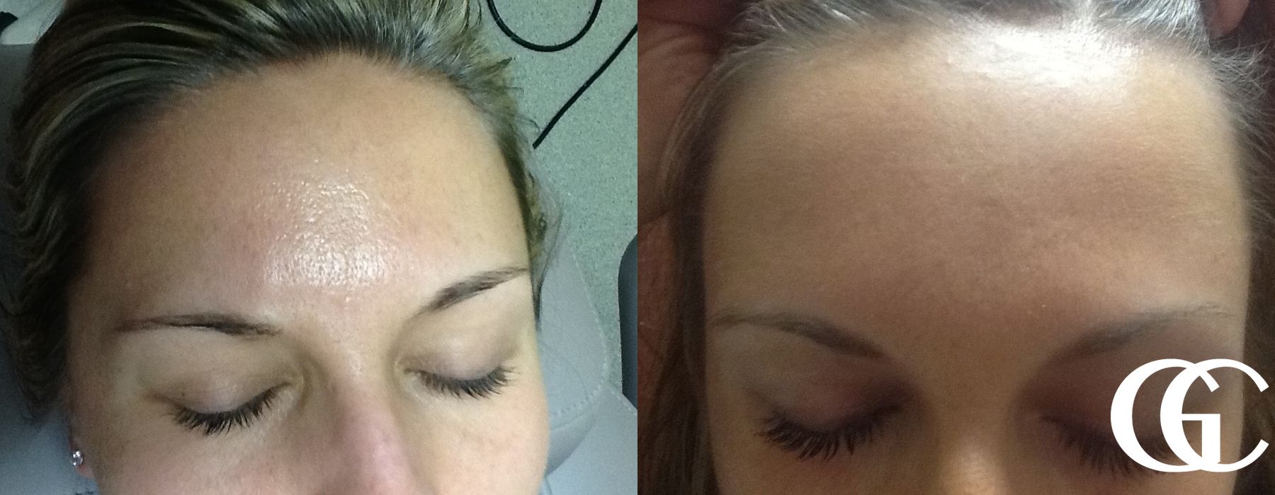 SkinPen® - Case 7472