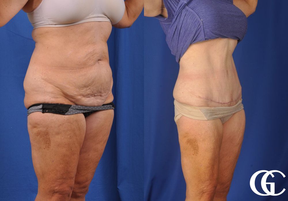 Liposuction - Thumbnail 3