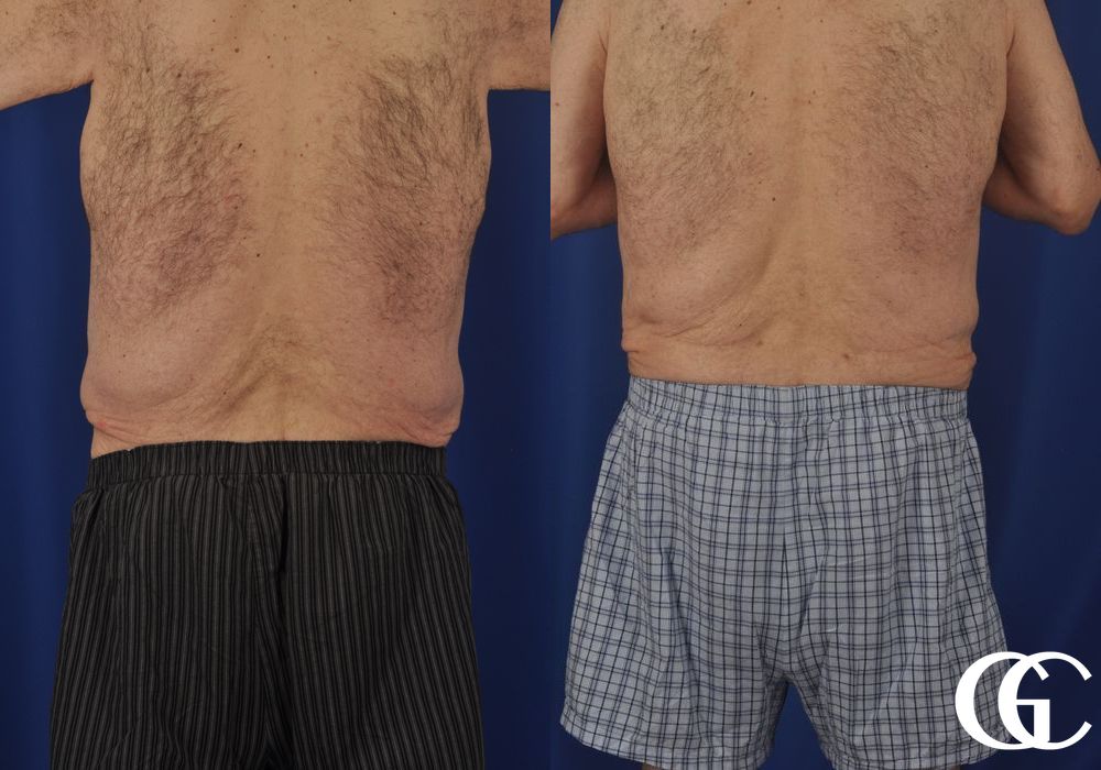 Liposuction - Case 6972